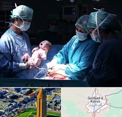 جراح سزارین در گنبد کاووس
