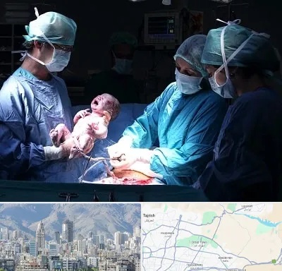 جراح سزارین در شمال شرق تهران