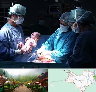 جراح سزارین در فومن