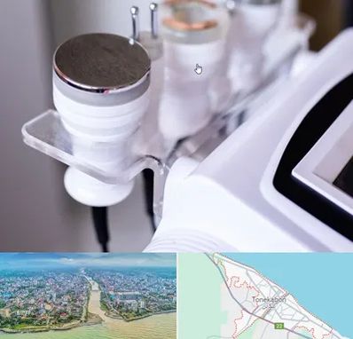 مرکز لاغری با کویتیشن در تنکابن