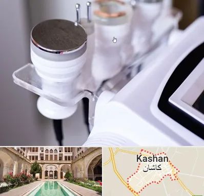 مرکز لاغری با کویتیشن در کاشان