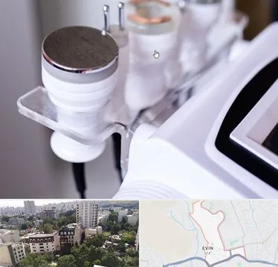 مرکز لاغری با کویتیشن در اوین