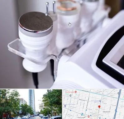 مرکز لاغری با کویتیشن در امامت مشهد 