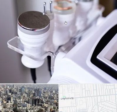 مرکز لاغری با کویتیشن در جیحون