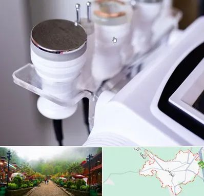 مرکز لاغری با کویتیشن در فومن