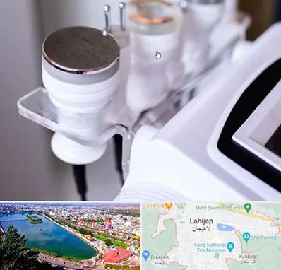 مرکز لاغری با کویتیشن در لاهیجان