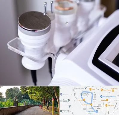 مرکز لاغری با کویتیشن در بلوار گیلان رشت 