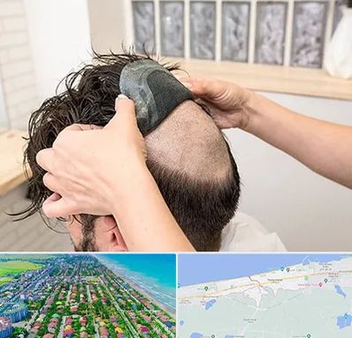 پروتز مو در فریدونکنار