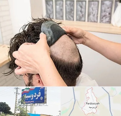 پروتز مو در فردوسیه شهریار