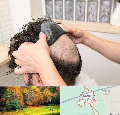 پروتز مو در کردکوی