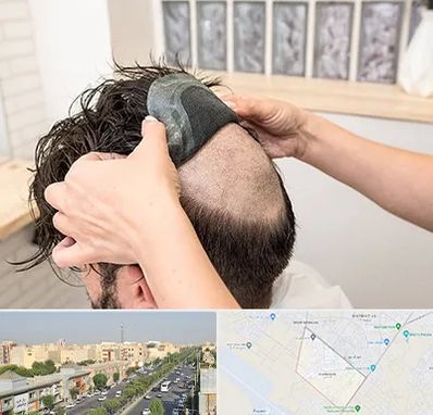 پروتز مو در کیانمهر کرج 