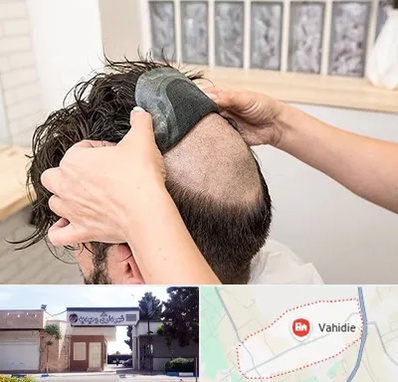 پروتز مو در وحیدیه شهریار