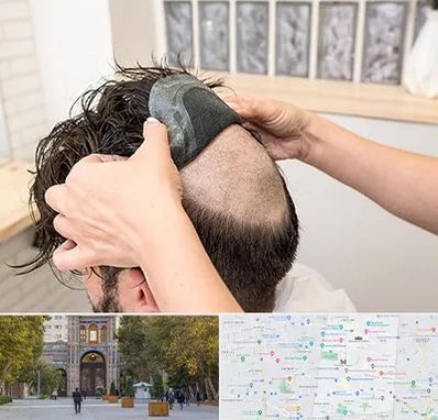 پروتز مو در منطقه 12 تهران 