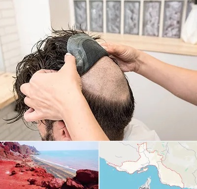 پروتز مو در هرمزگان