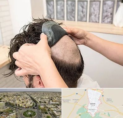 پروتز مو در قزوین