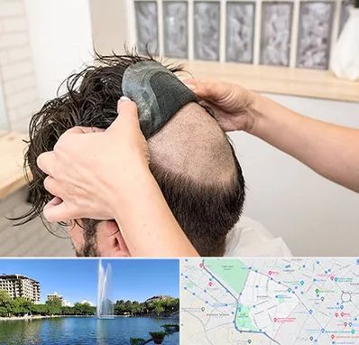 پروتز مو در کوهسنگی مشهد 