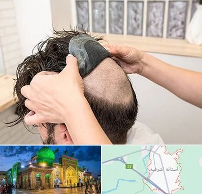 پروتز مو در آستانه اشرفیه