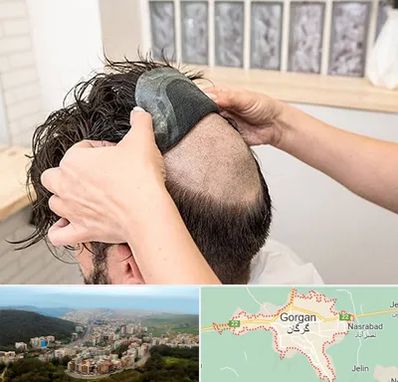 پروتز مو در گرگان