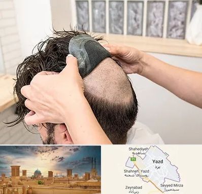 پروتز مو در یزد