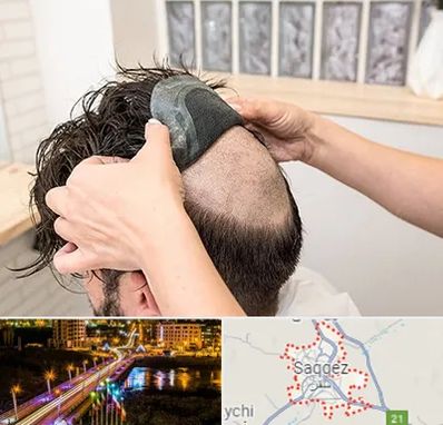 پروتز مو در سقز