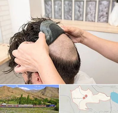 پروتز مو در خاش