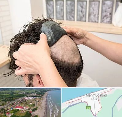 پروتز مو در محمودآباد