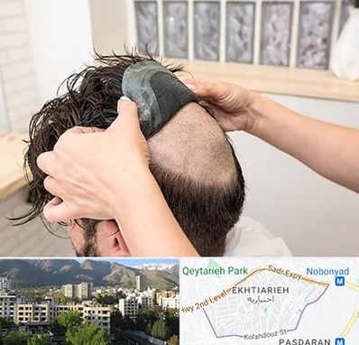 پروتز مو در اختیاریه 