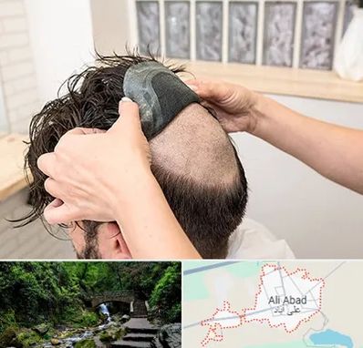 پروتز مو در علی‌ آباد کتول