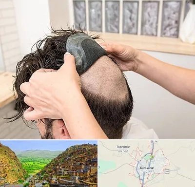 پروتز مو در کامیاران