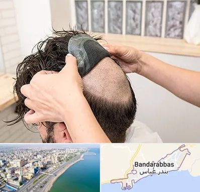 پروتز مو در بندرعباس