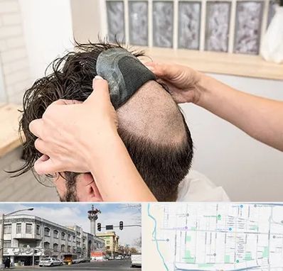 پروتز مو در 17شهریور