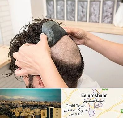 پروتز مو در اسلامشهر