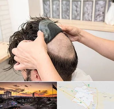 پروتز مو در قوچان