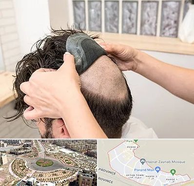 پروتز مو در پرند