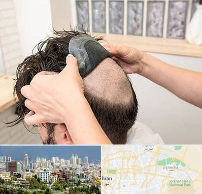 پروتز مو در شرق تهران 