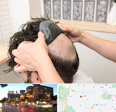 پروتز مو در بلوار سجاد مشهد 