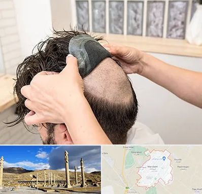 پروتز مو در مرودشت