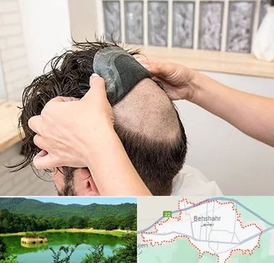 پروتز مو در بهشهر