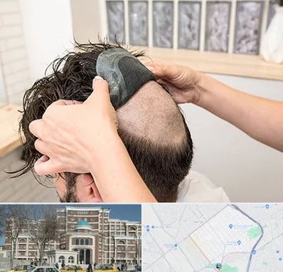 پروتز مو در طلاب مشهد