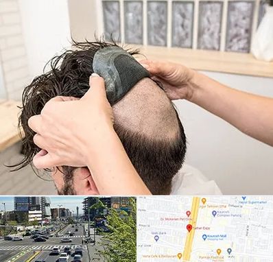 پروتز مو در ستاری 