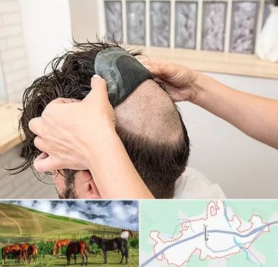 پروتز مو در تالش