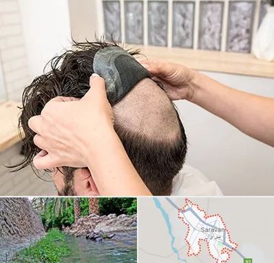 پروتز مو در سراوان