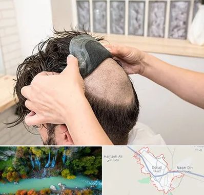 پروتز مو در دورود