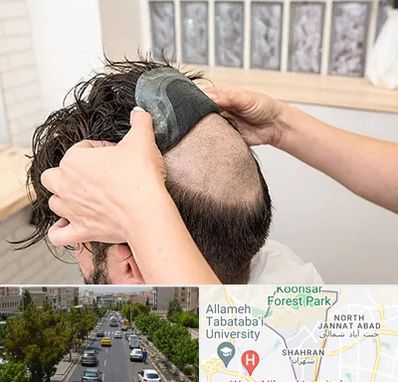 پروتز مو در شهران 