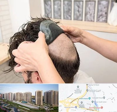 پروتز مو در المپیک 
