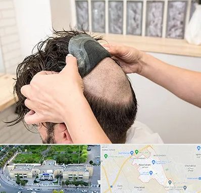 پروتز مو در نسیم شهر