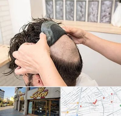 پروتز مو در عطاران قم