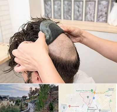 پروتز مو در باغستان کرج 