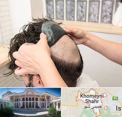 پروتز مو در خمینی شهر