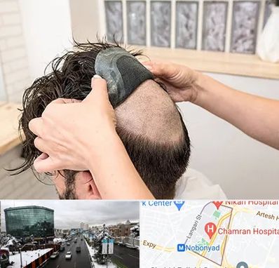 پروتز مو در اقدسیه 